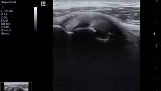 Subscapularis tear  MSK ultrasound [upl. by Oad58]