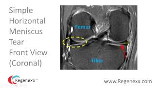 How to Read a Knee MRI for Meniscus Tears [upl. by Brantley]