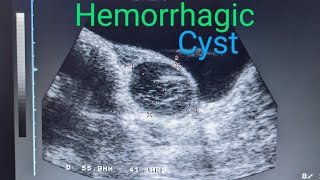 Ovary Hemorrhagic Cyst medicalimagingbyzubair ultrasound [upl. by Pournaras]