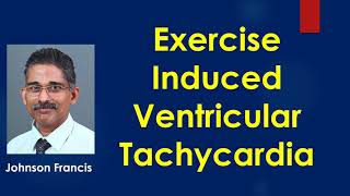 Exercise Induced Ventricular Tachycardia [upl. by Penelope]