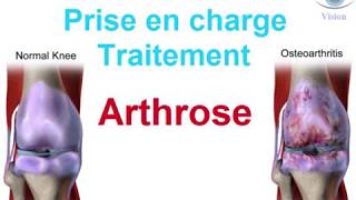 Traitement de lArthrose douleur cervicale du genou How to treat osteoarthritis [upl. by Anyl]