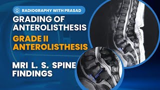 Understanding Grade II Anterolisthesis in the Lumbar Spine  Causes Symptoms and Solutions [upl. by Gnahc]