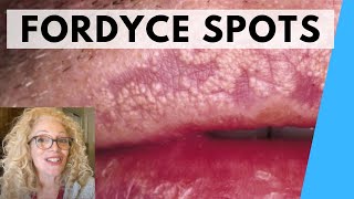 SYRINGOMA VS FORDYCE SPOTS  NATURAL REMEDIES [upl. by Blumenfeld]