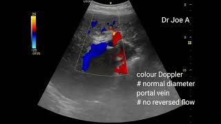 Coarse liver echotexture early sign of cirrhosis ultrasound video [upl. by Trinetta]