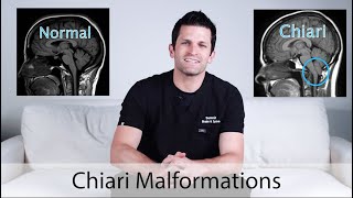 Chiari Malformations [upl. by Cirek]