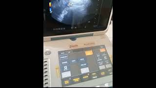 Esaote Mylab Gamma TVS pregnancy ultrasound medicalequipment [upl. by Ahsok]