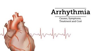 Supraventricular tachycardia SVT [upl. by Adnor]