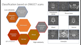 Multiparametric Imaging Patterns of Untreated Bone Metastases [upl. by Ayikan735]