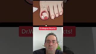 ASMR INGROWN TOENAIL REMOVAL 😜 shorts asmr ingrowntoenail [upl. by Krein907]