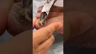 SEVERE Toenail FUNGUS Treatment 😳  ingrown pedicure [upl. by Cargian]