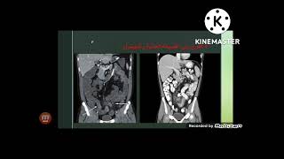 CT ENTEROGRAPHY كيفية عمل فحص اشعة مقطعية علي الامعاء [upl. by Eux]