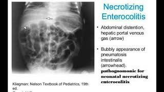 Necrotizing enterocolitis2 [upl. by Nylaras]