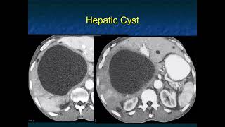 CT Evaluation of Liver Masses Key Differential Diagnosis Pathways  Part 1 [upl. by Frankie]