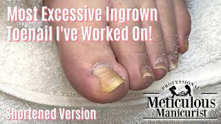 Most Extreme Ingrown Toenail Salon Pedicure  Shortened [upl. by Ytirahs699]