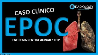 EPOC 🫁  ENFISEMA pulmonar CENTROACINAR  Caso CLINICO 🧑🏻‍⚕️ [upl. by Pasahow]