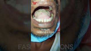 Tongue Fasciculations  Motor Neuron Disease  Dr Shankar Dey [upl. by Ennahoj]