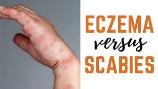 Scabies vs Eczema Causes Symptoms amp Treatments [upl. by Gypsie]