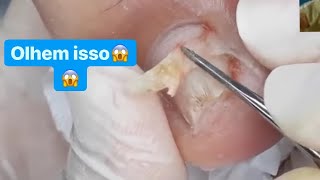 VOCÊS NÃO PODEM DEIXAR DE ASSISTIR ESSE DESENCRAVANDO 😰 Podologa Nagel [upl. by Enived703]