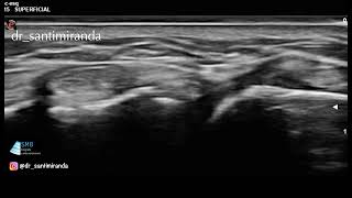 post traumatic gross instability of distal radioulnar joint [upl. by Aileen276]