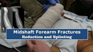 Reduction amp Splinting of Forearm FracturesQuick Version [upl. by Durston]