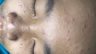 ACNE TREATMENT VU QUYNH MI  Blackheads Chin amp Nose Of Tweens 2024 EX [upl. by Hurlee]