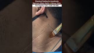 Chemical peeling for acanthosis nigricans black neck at skinaa clinic Viral shorts [upl. by Ttnerb215]