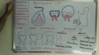 Dentigerous cyst [upl. by Yl746]