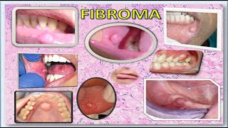 Fibroma [upl. by Ivens250]