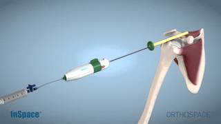 Orthospace Arthroscopic Procedure animation [upl. by Bevus]