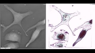 Lung cancer cells under 3D microscope [upl. by Myranda]