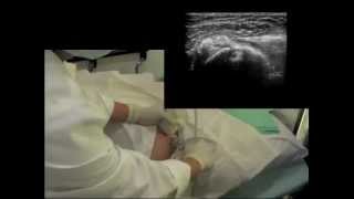 Calcific Subscapularis Tendinitis  QMH AED Ultrasound Casebook 201209 Video 3 [upl. by Rhody]