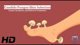 Candida Fungus Skin Infection Explained What You Need to Know [upl. by Azmah17]