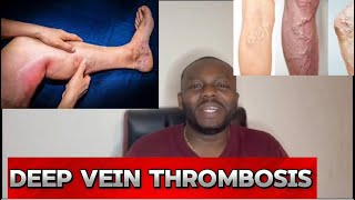 Causes And Effects Of Deep Veins Thrombosis dvt [upl. by Ludovico593]