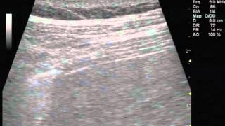 Ultrasonography of Normal and Paralyzed Diaphragms [upl. by Salman562]