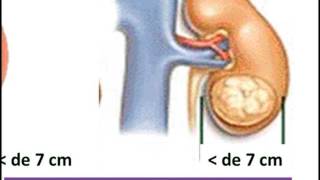 Tumores del Riñón Generalidades y Etapas clinicas [upl. by Alaekim]