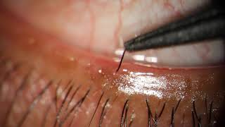 Removing Eyelash Growing Into Eye through Meibomian Gland [upl. by Onairelav]