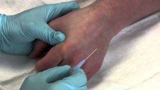 Intravenous Catheter Placement [upl. by Vitalis189]