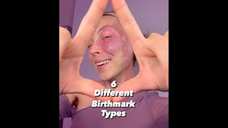 6 Different Birthmark Types [upl. by Umeko]