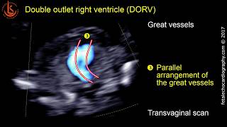 Fetal echocardiography at 1113 weeks Double Outlet Right Ventricle DORV [upl. by Adne]