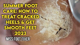 Summer Foot Care How to Treat Cracked Heels and Get Smooth Feet by foot Specialist Miss foot Fixer [upl. by Harp804]