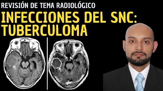 Radiología en 5 minutos Infecciones del sistema nervioso central Tuberculoma [upl. by Llener772]