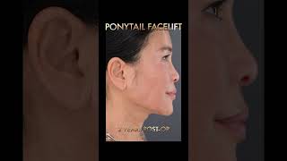 Unbelievable Before And After Transformation  What Do You Notice ponytailfacelift facelift [upl. by Yousuf]