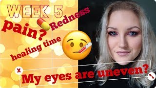 Strabismus surgery squintlazy eye update  Recovery week 5 [upl. by Kalvin]