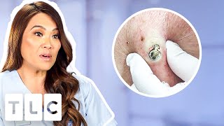 Top 5 Pimple Popping Moments From A 55YearOld Blackhead To Oozing Fistulas [upl. by Alocin]