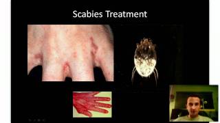 Scabies Treatment  Kill Scabies Now [upl. by Harlow]