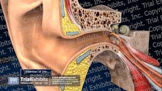 Tympanic Membrane Perforations [upl. by Victoria]