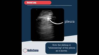 Lung Ultrasound for Beginners Pneumothorax [upl. by Kirby403]