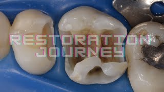 RESTORATIVE JOURNEY amalgam to composite [upl. by Hiroko]