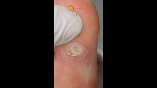 Exfoliation of plantar heloma with deep core Shorts [upl. by Ahsimaj]