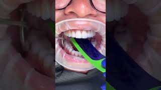 Dentist uses film to test tooth bite Note the bluefullingDIYdentist badbreath 🦷beadrepair [upl. by Nyladam]